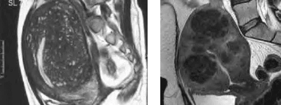 MRI của adenomyosis và u xơ tử cung