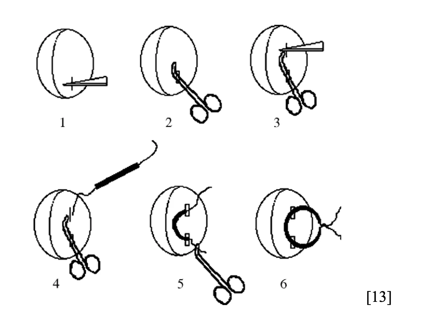 Giấu đầu ngoài catheter